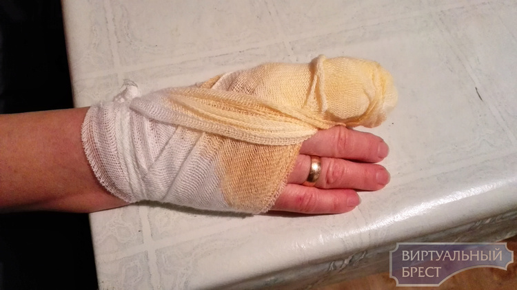 На посетительницу контактного зоопарка в Бресте напал енот и укусил за палец